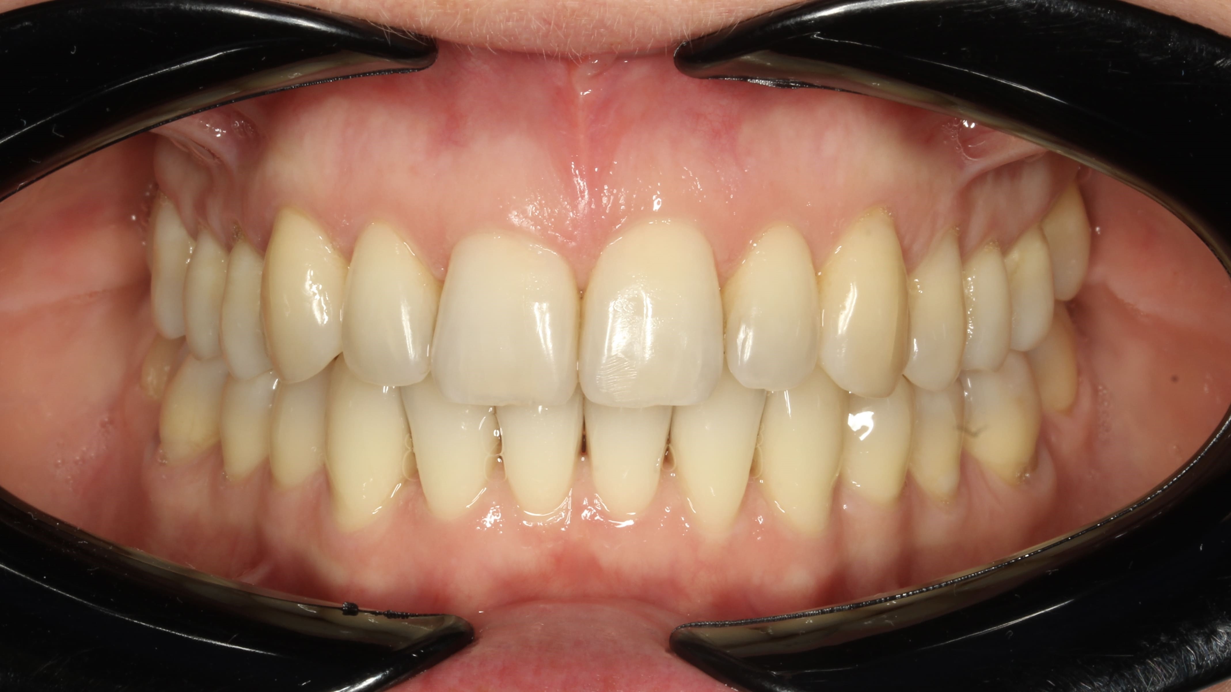 teeth before