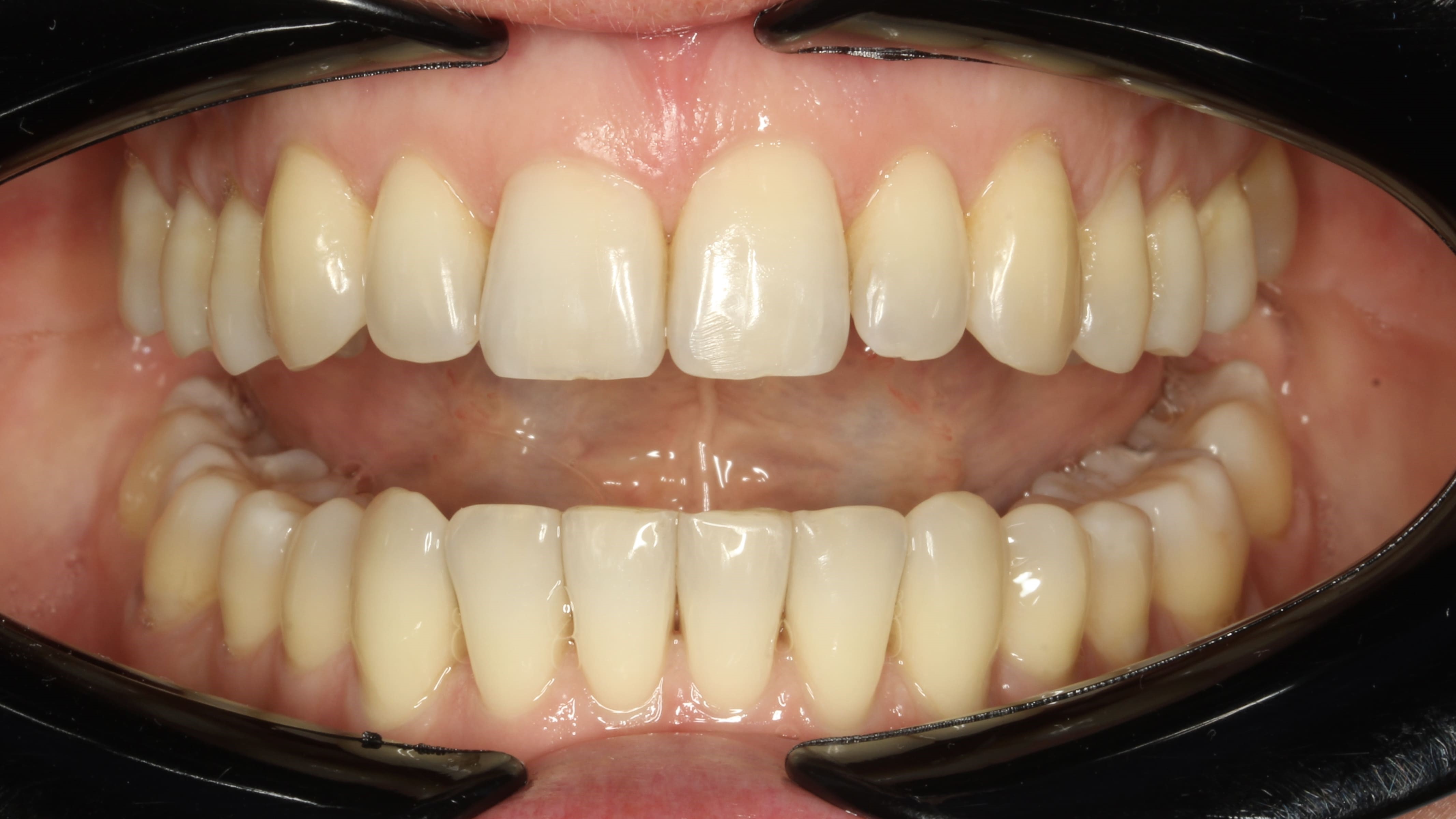 teeth before