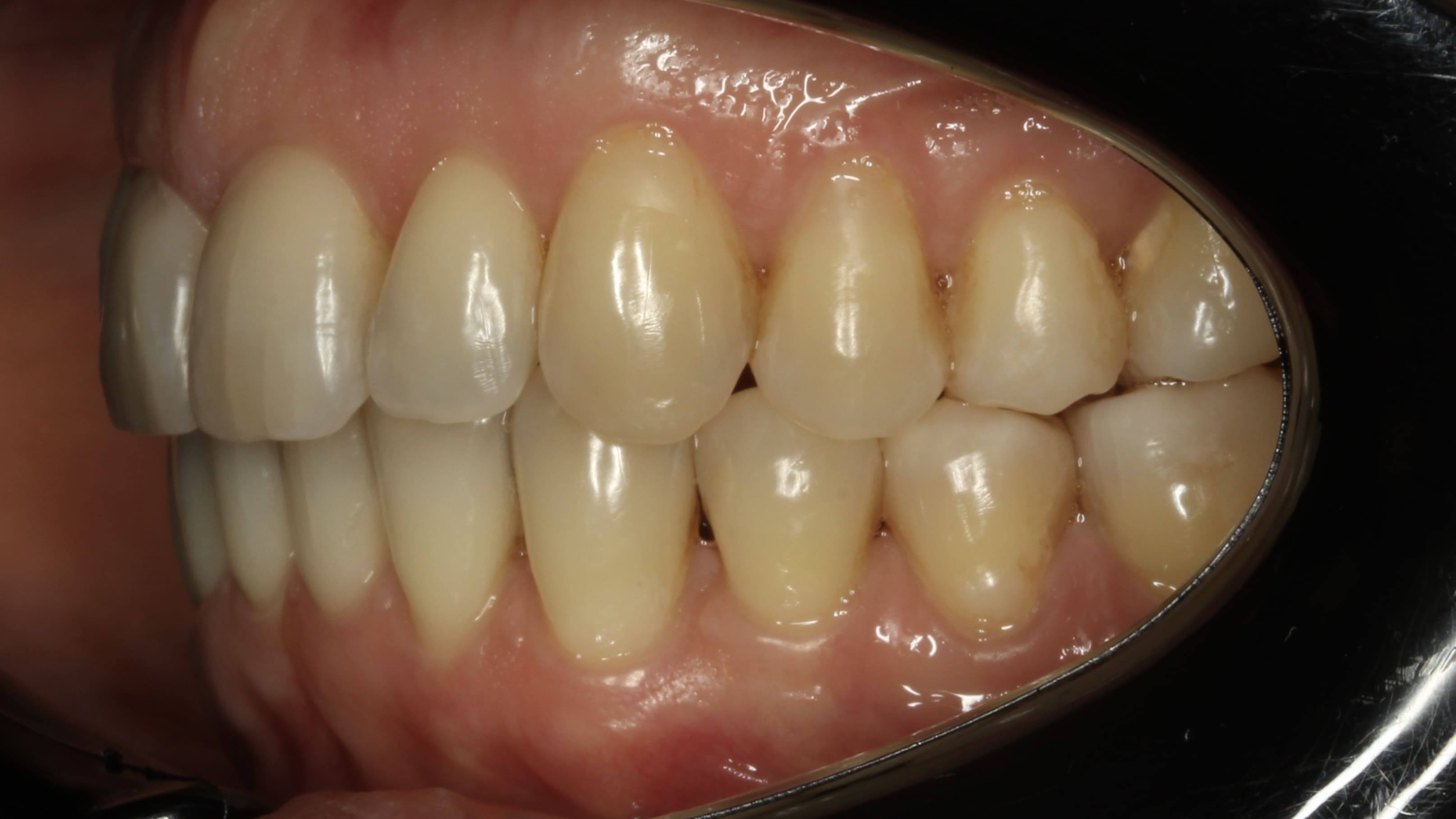 teeth before