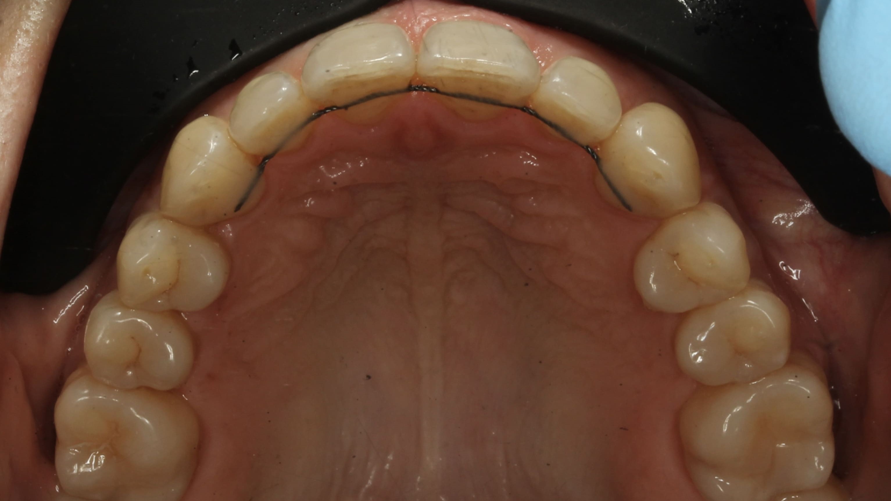 teeth before