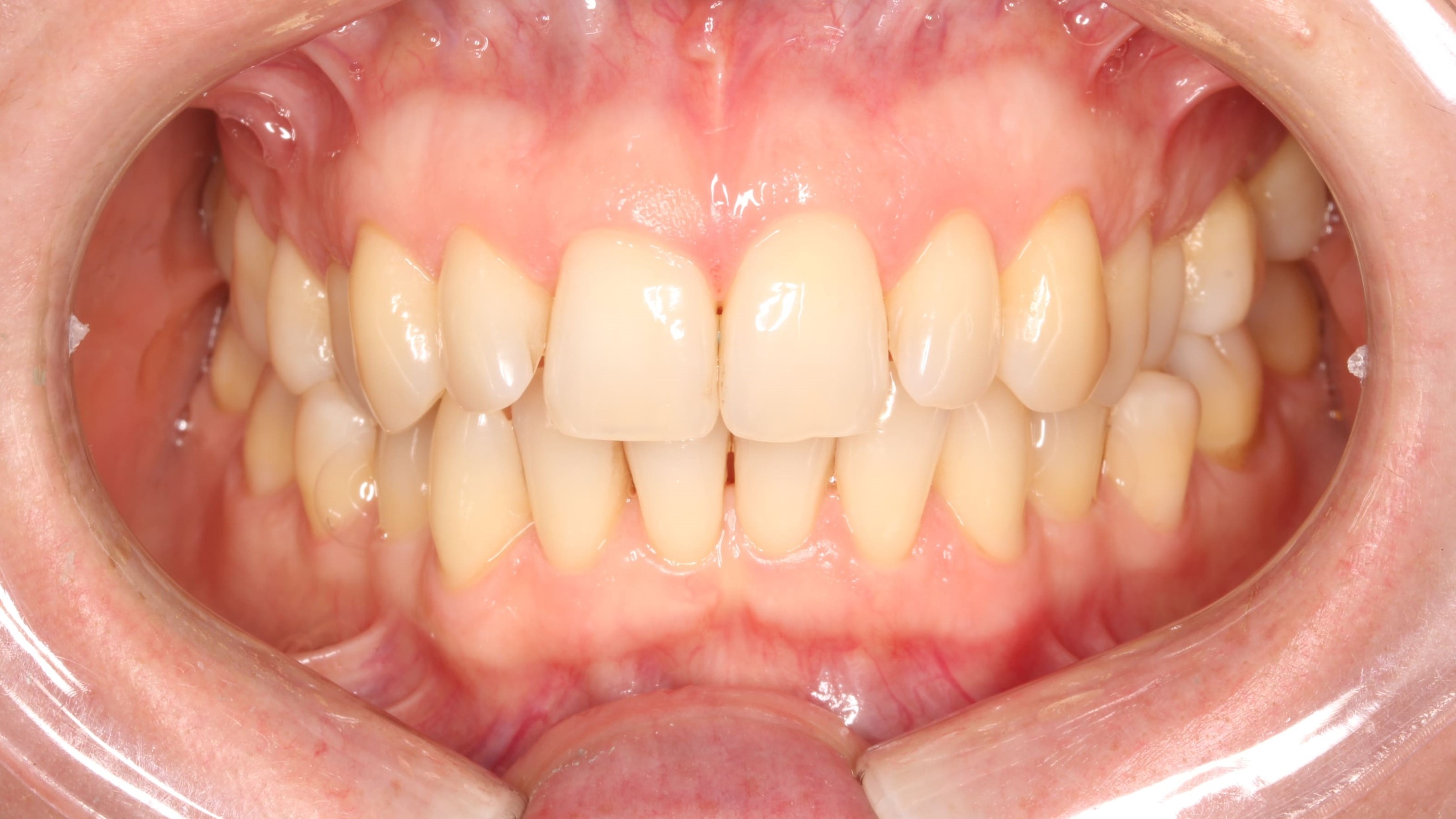 teeth before