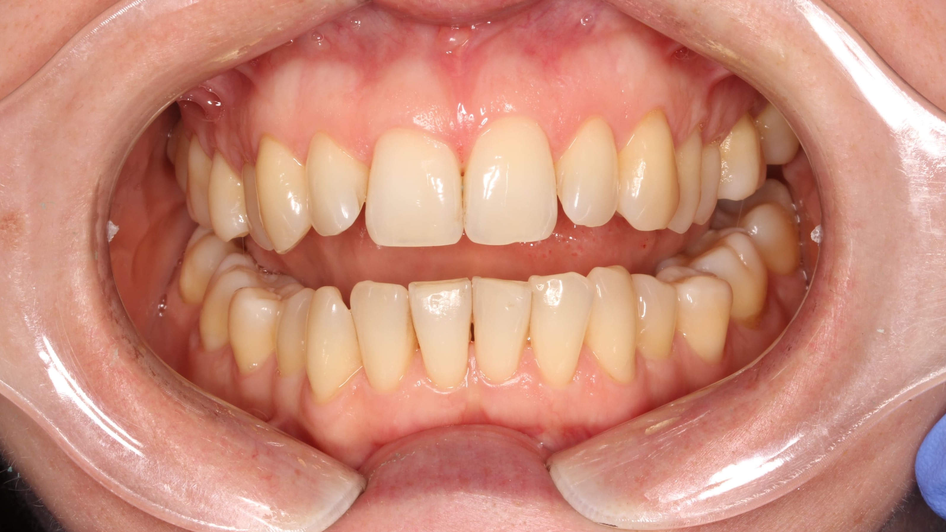 teeth before