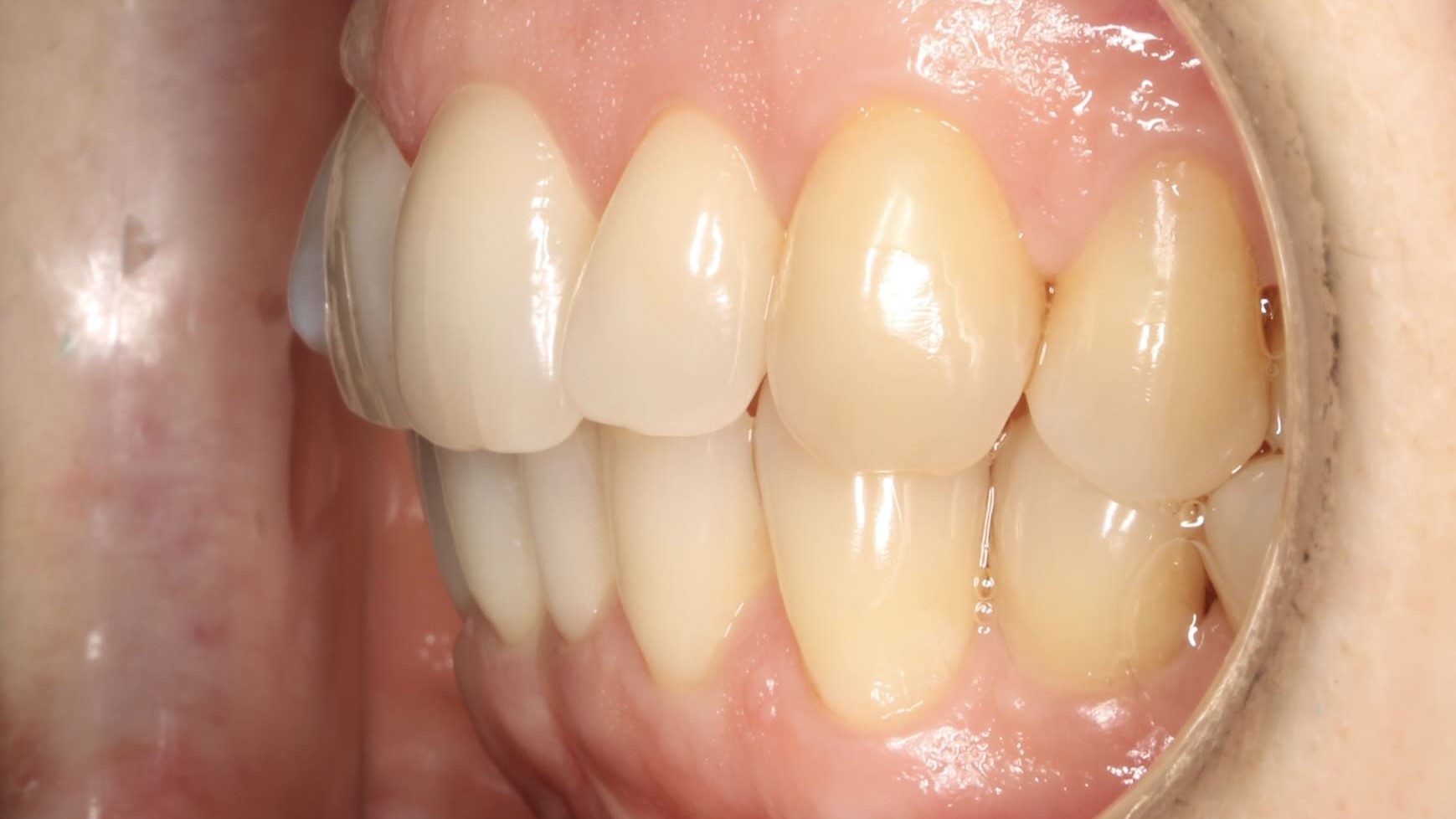teeth before