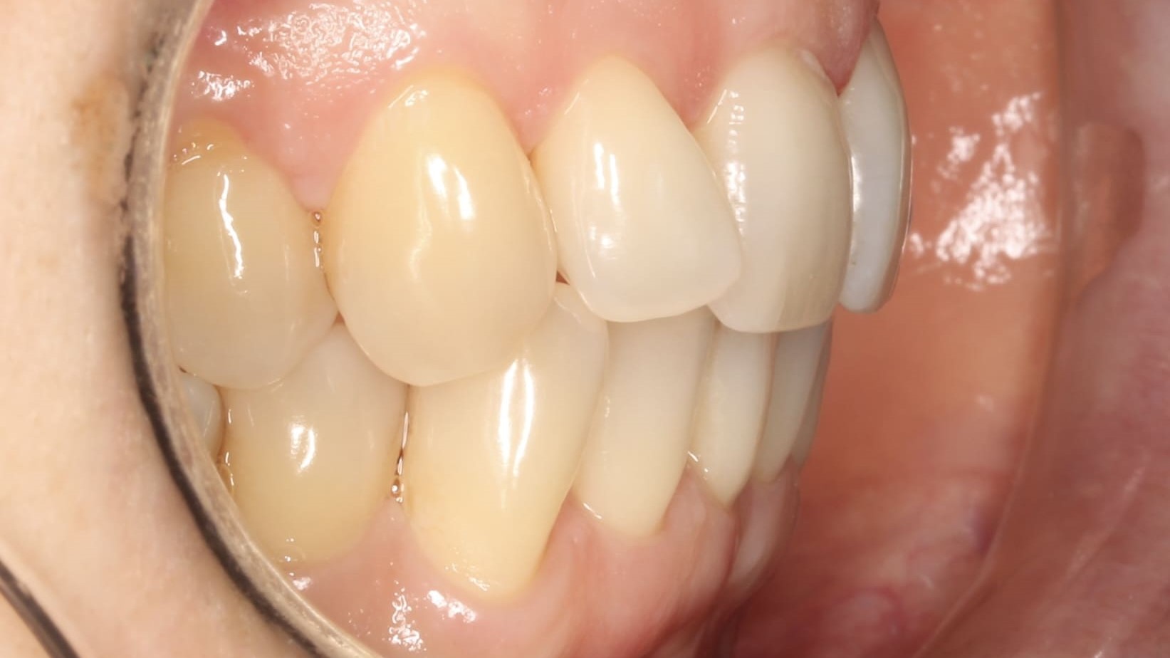 teeth before