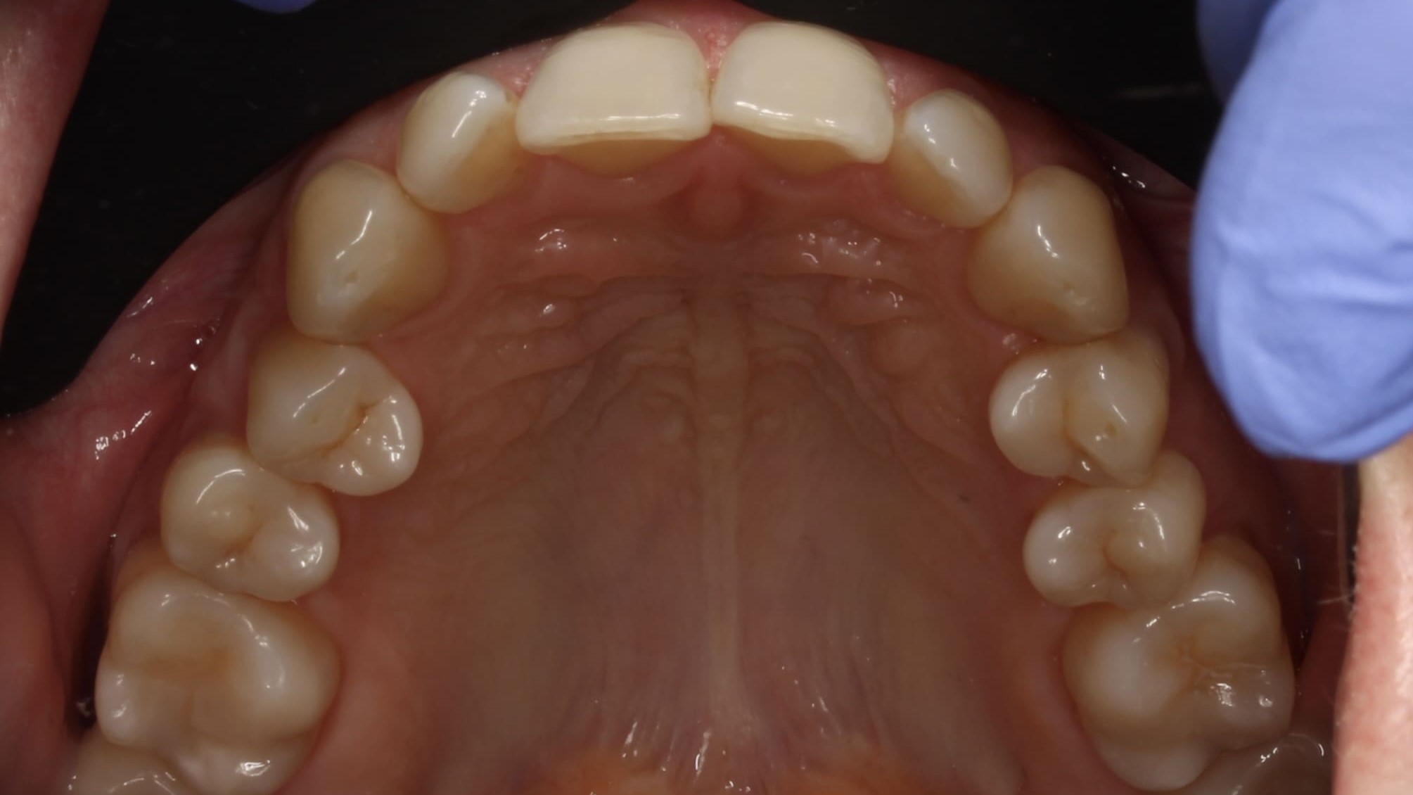teeth before