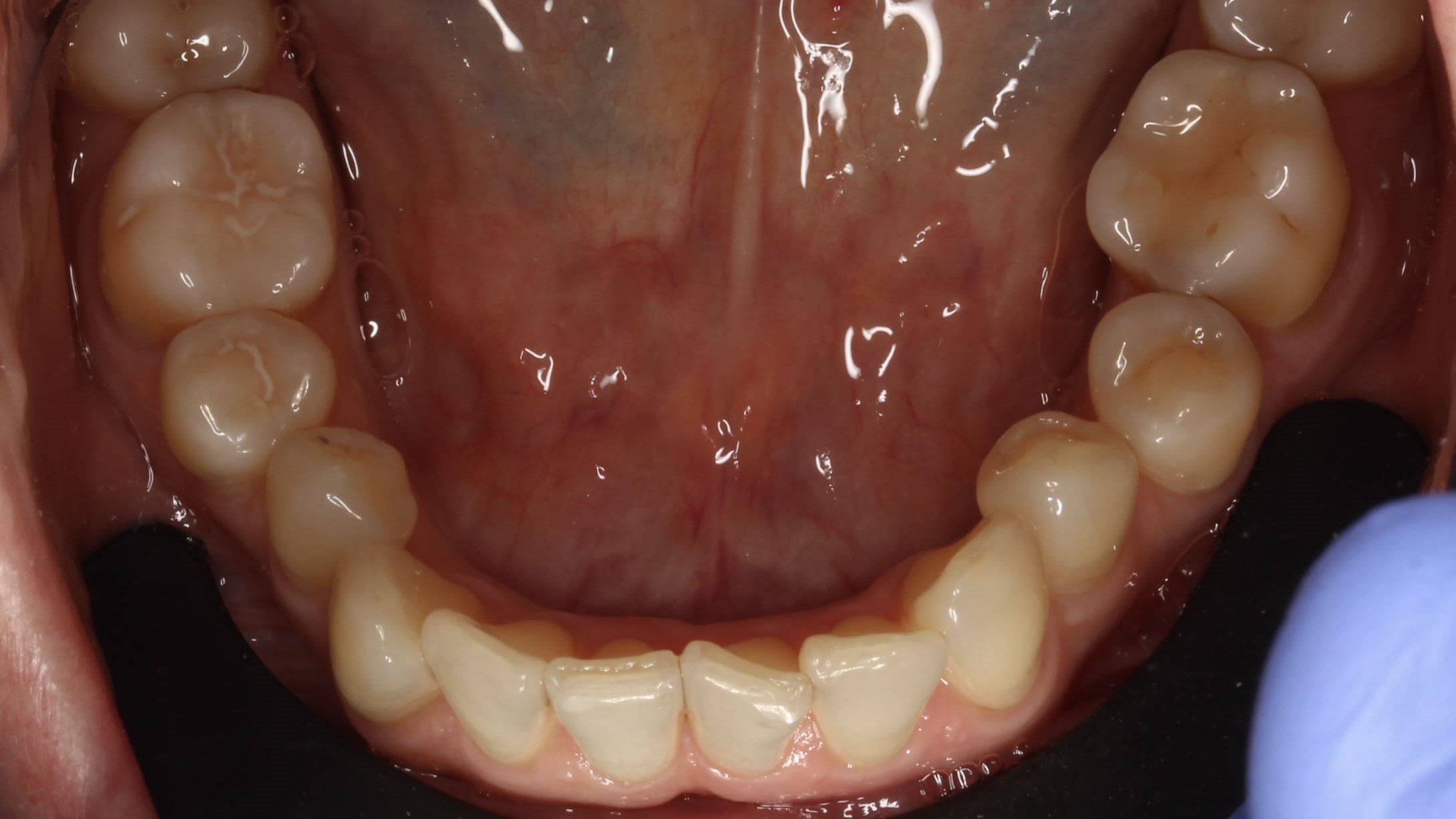 teeth before