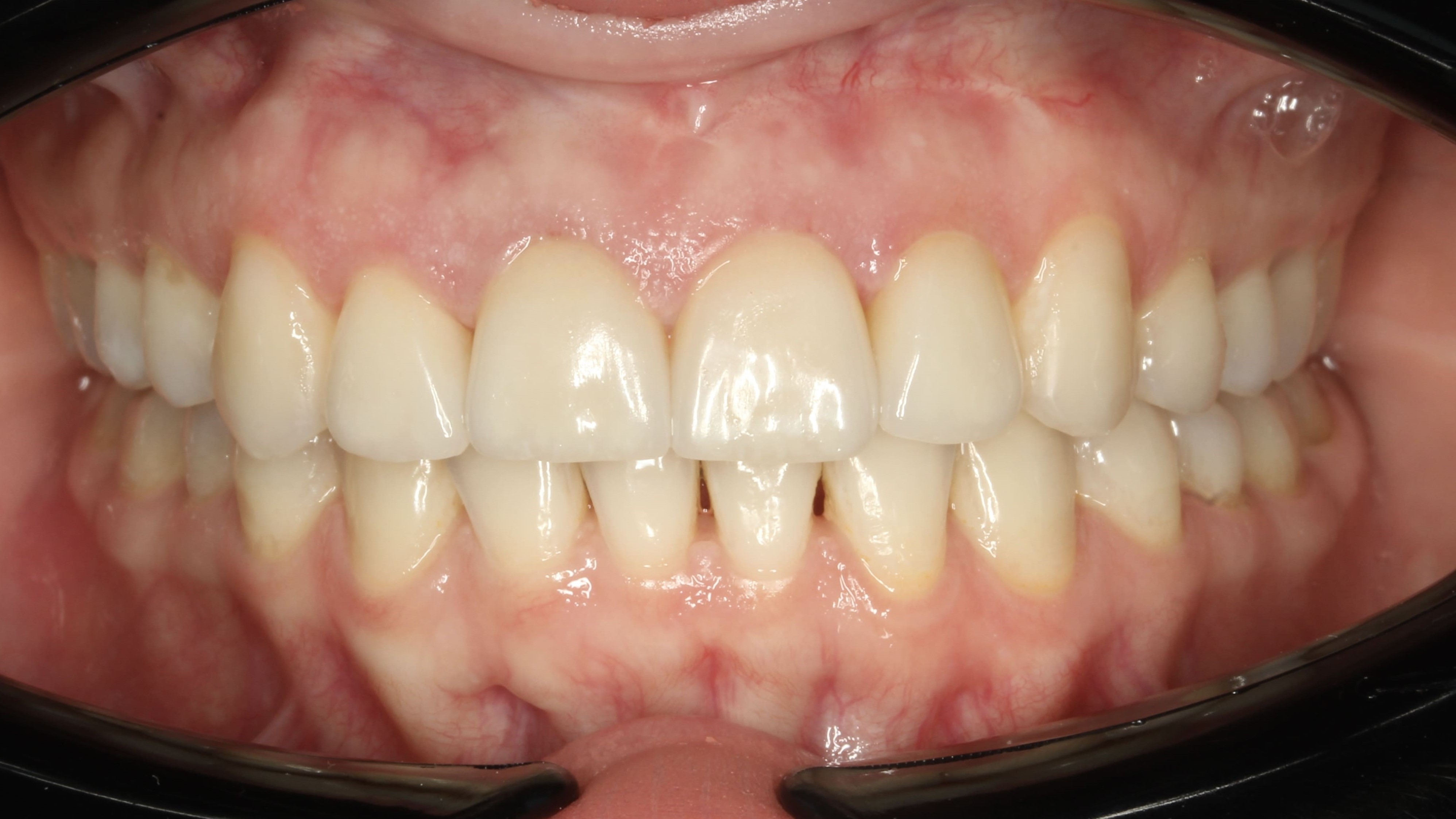 teeth before