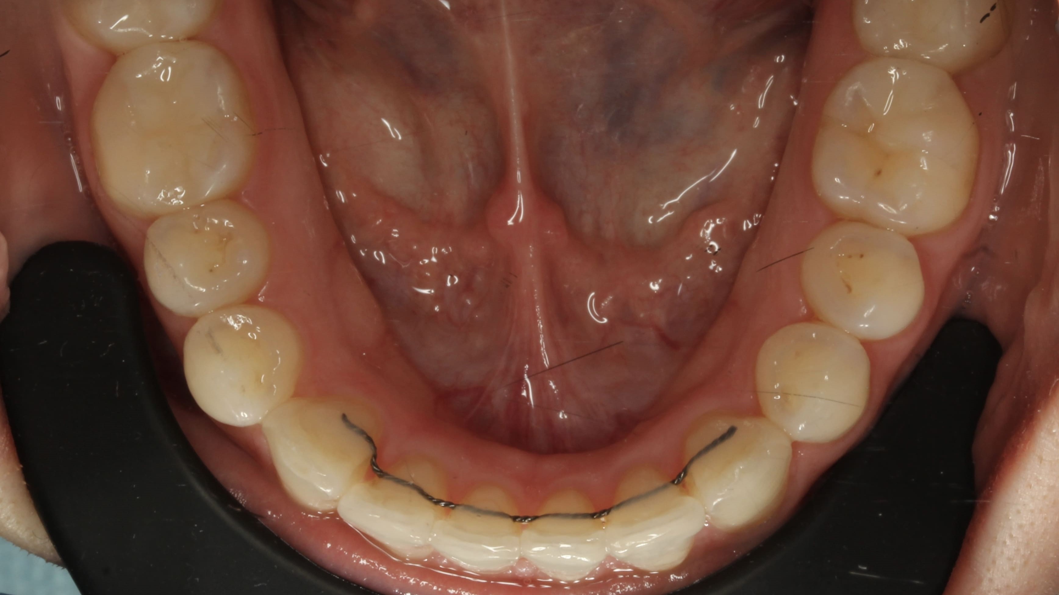 teeth before