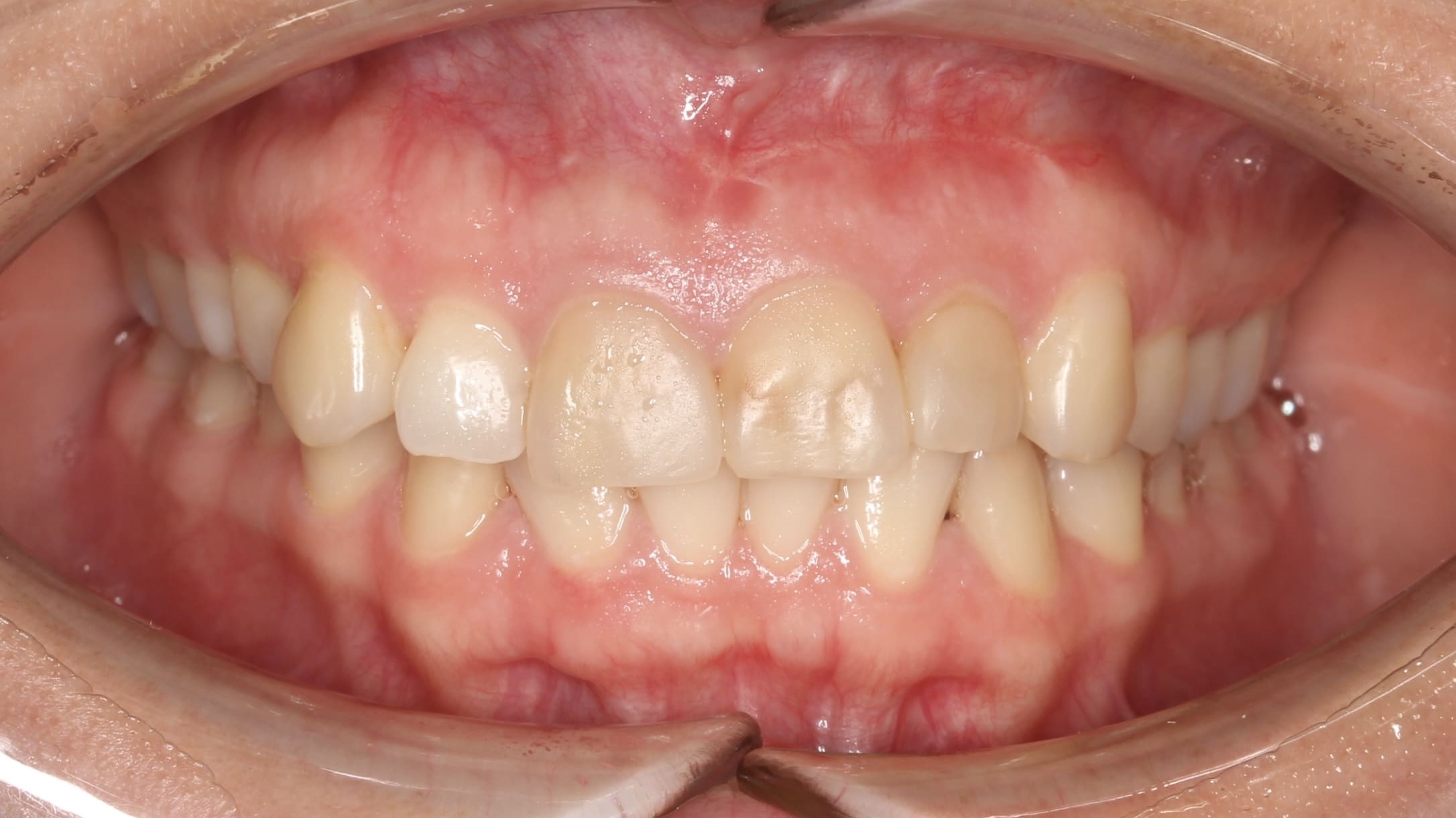 teeth before