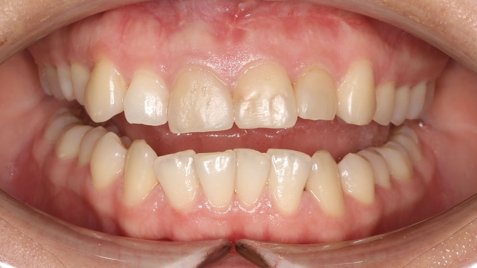 teeth before