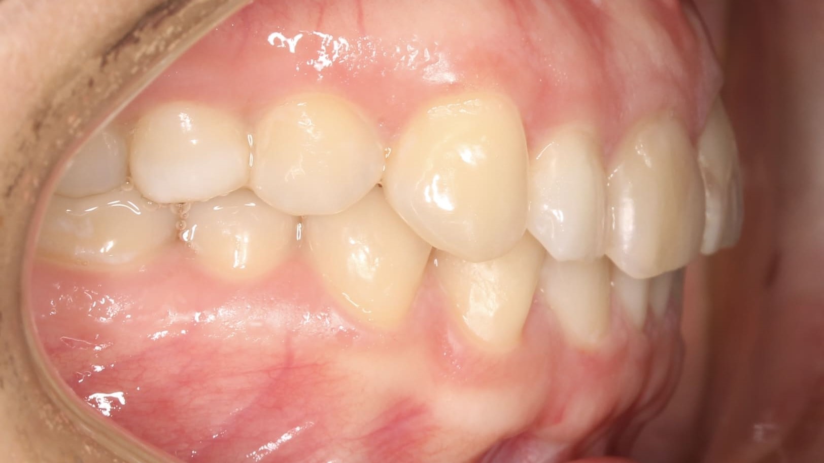 teeth before
