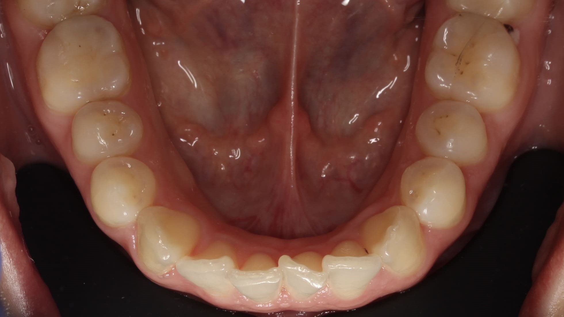 teeth before