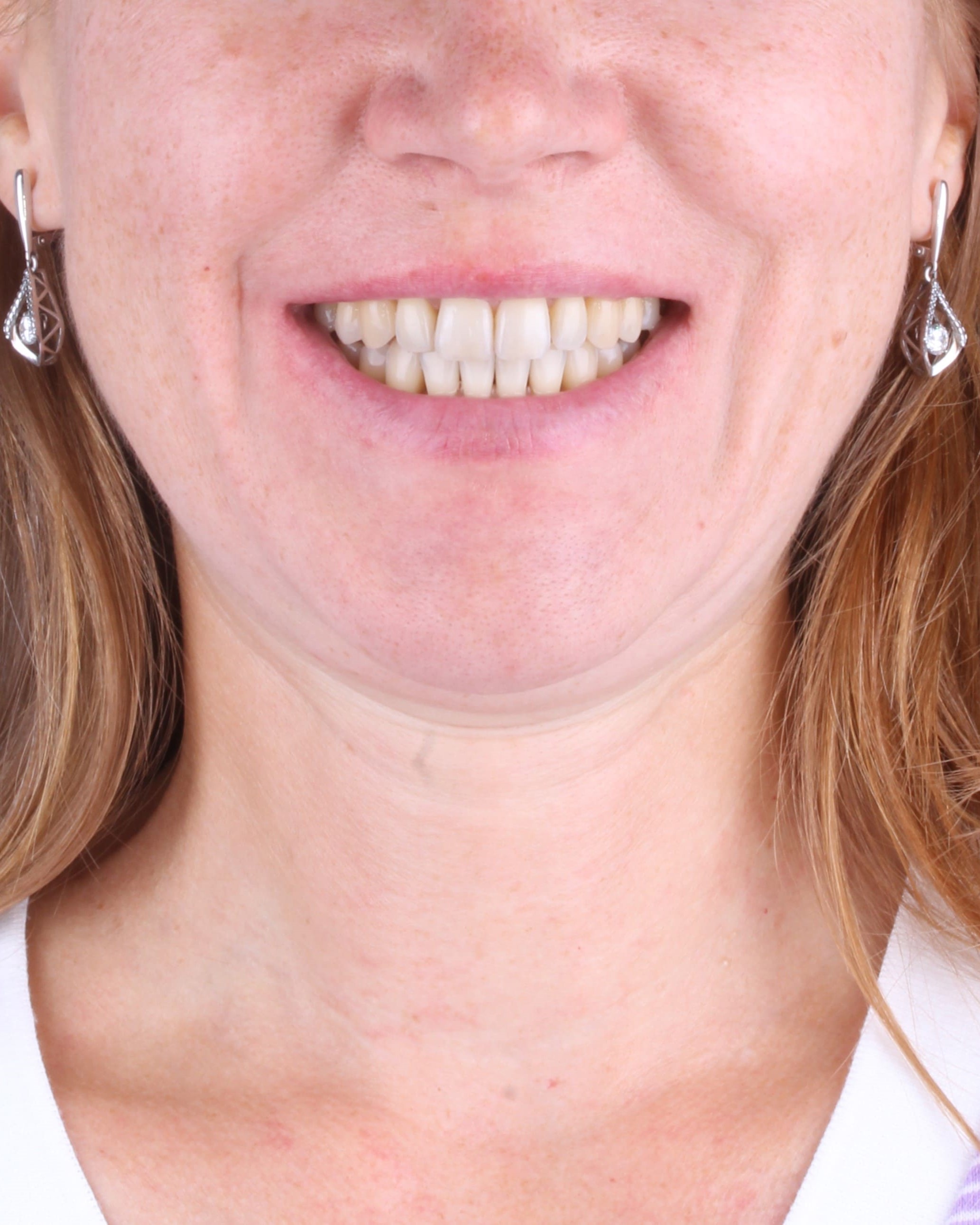 teeth before