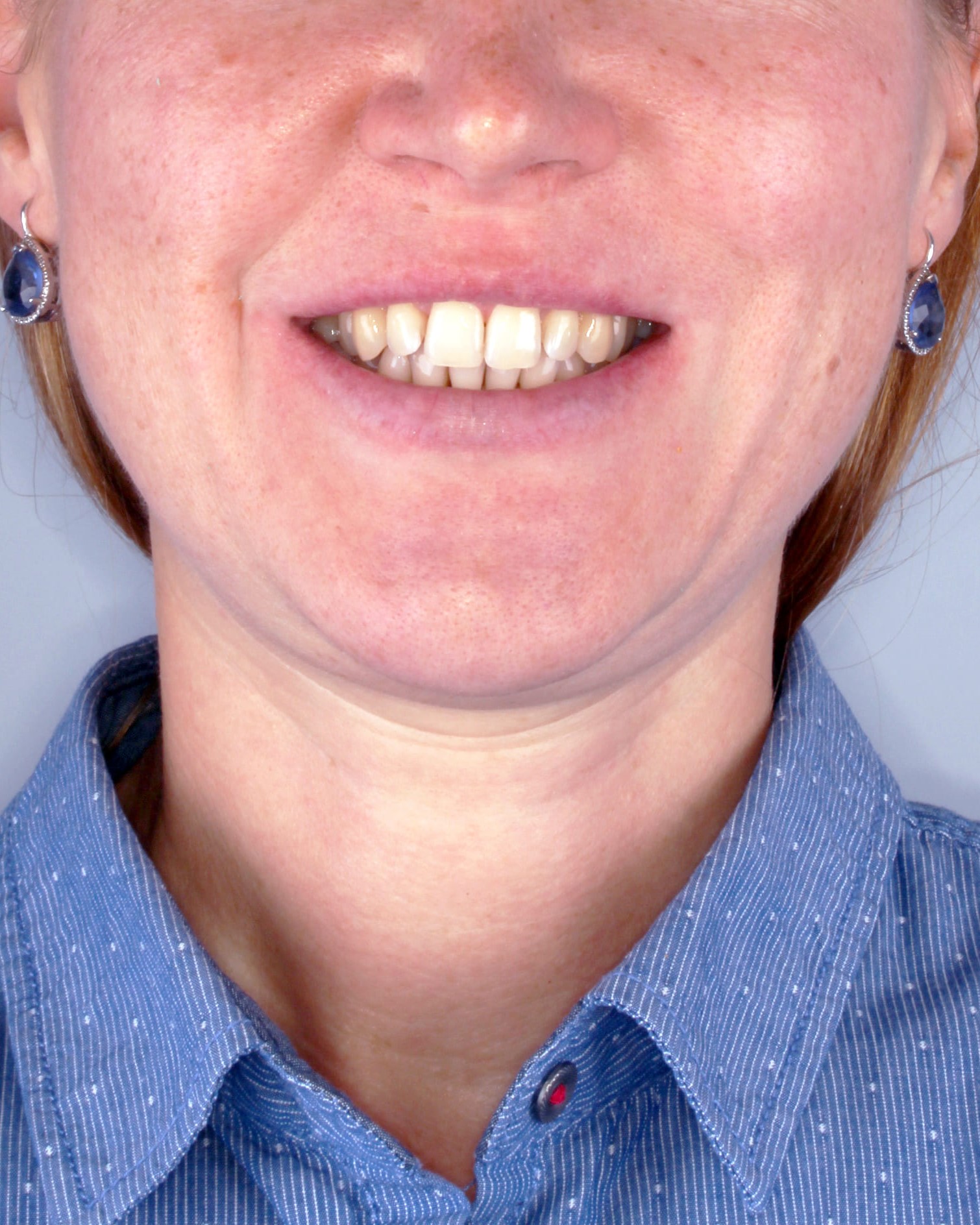 teeth before